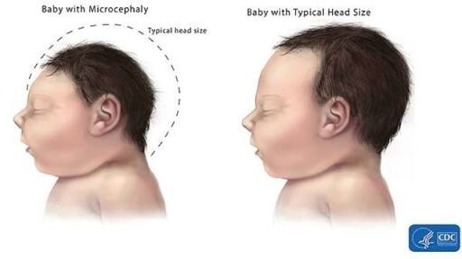ZIKA BABY